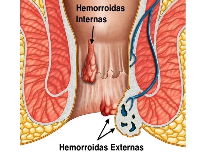 Ilustração dos tipos de hemorroidas