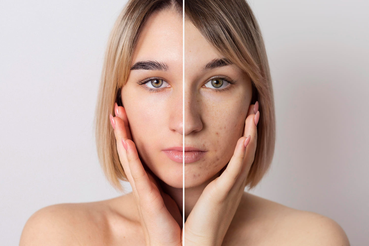 Imagem antes e depois de mulher após procedimento de peeling facial