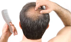 prostaquinon, alopecia e queda de cabelos