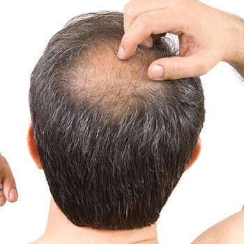 prostaquinon, alopecia e queda de cabelos